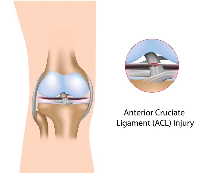 ACL injury