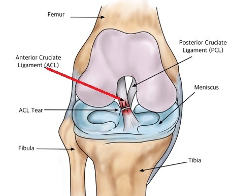 ACL_Tear ACL_Tear