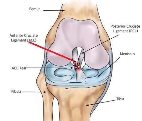 ACL_Tear