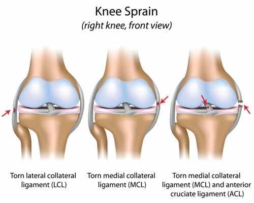 CrossFit Knee injuries-1 CrossFit Knee injuries-1