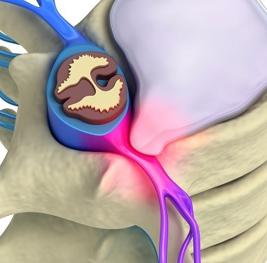 Herniated disc-1-min-8_0