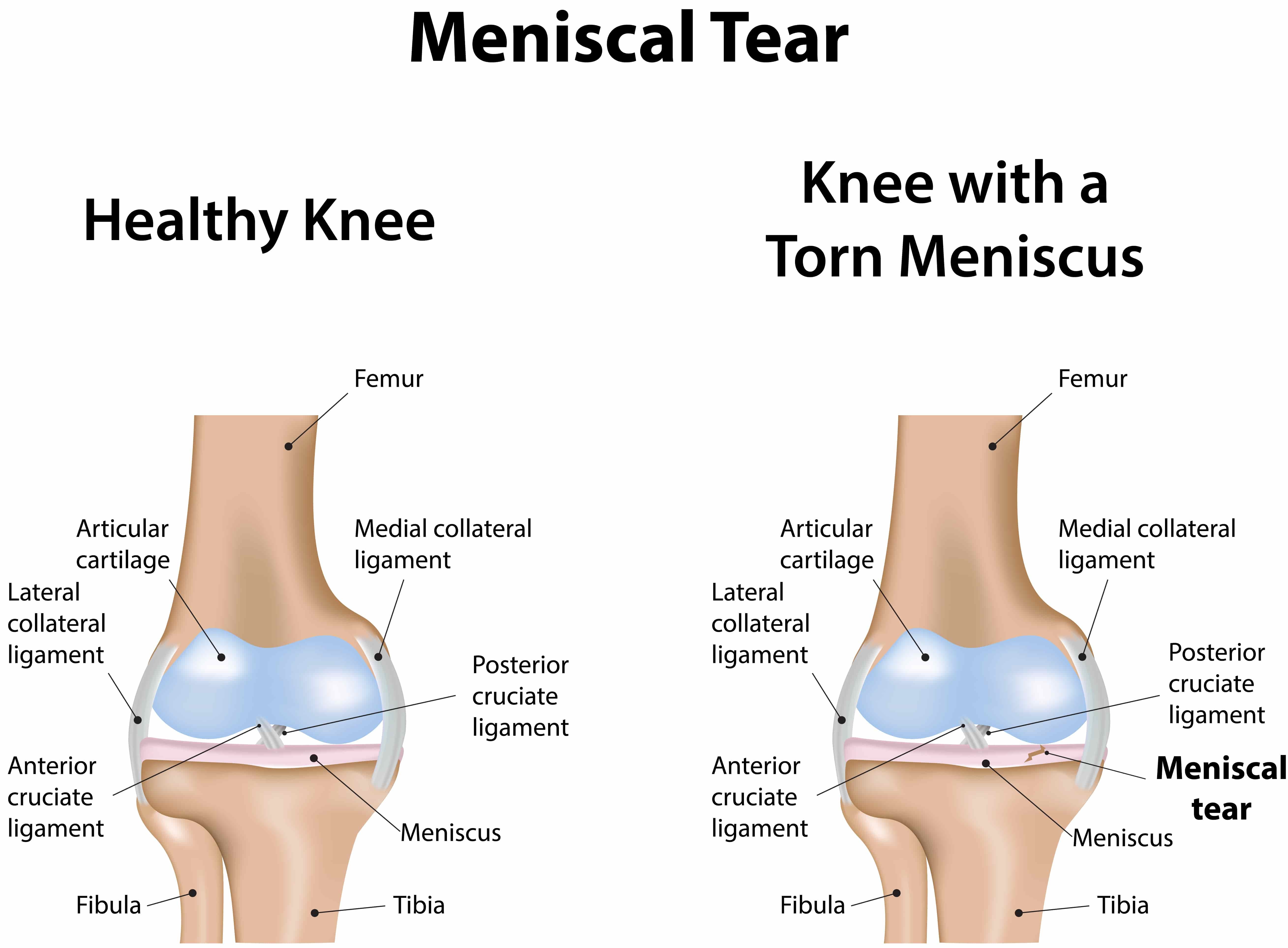 Meniscus-Knee-Injury_0