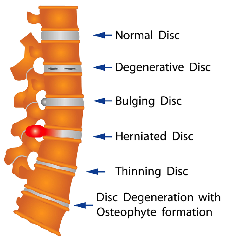 correct squat form to avoid disc damage and herniated disc