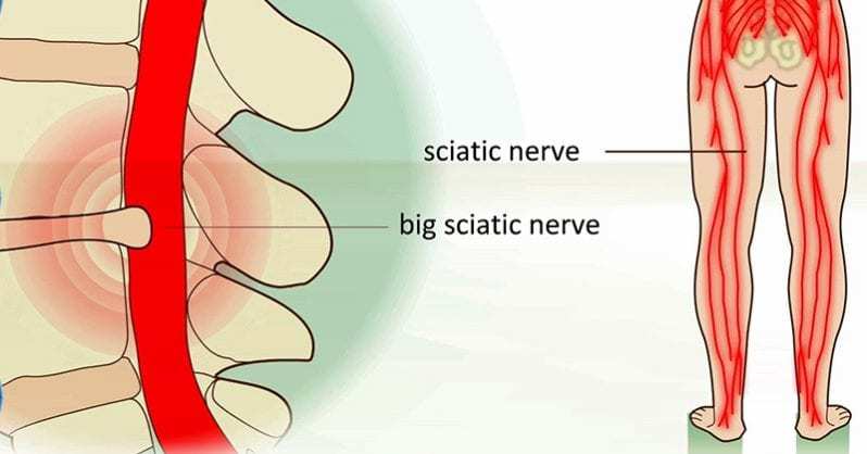 Pain down both the legs? Can it be sciatica