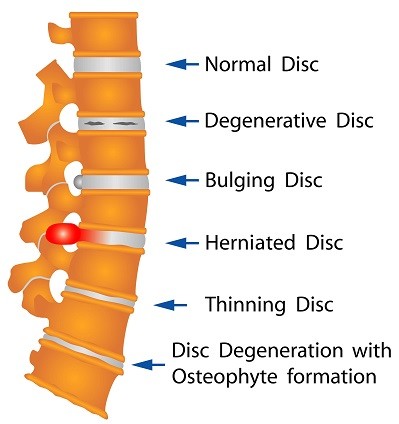 Types of grading back pain