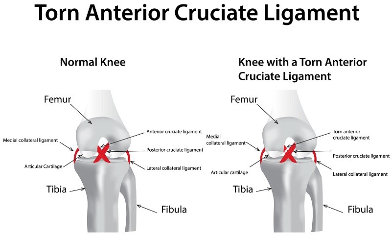 Torn Anterior Cruciate Ligament