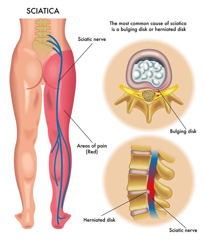 Sciatica Pain Rehabilitation