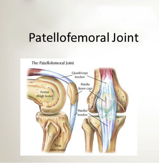 Patellofemoral pain syndrome