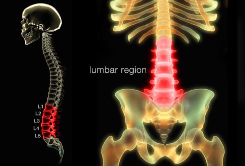 Herniated Disc