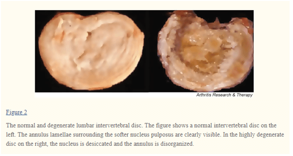 Disc degeneration 