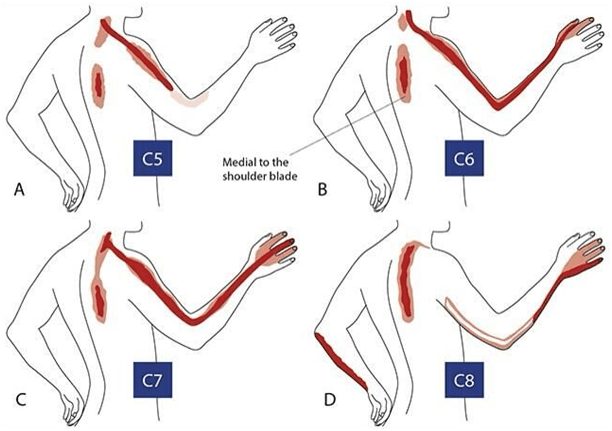 Cervical Disc Herniation