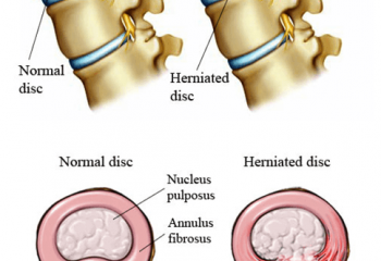 leading-back-injury