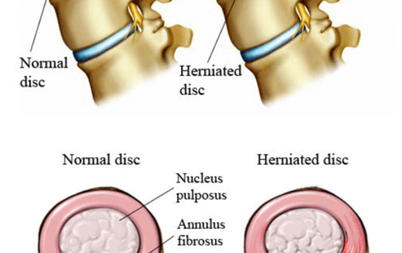 leading-back-injury