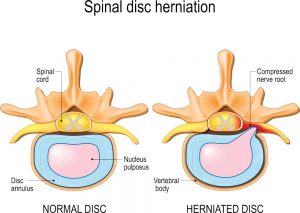 Disc herniation