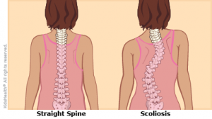 adults suffering from scoliosis