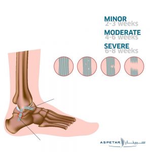 Grades of ankle sprain