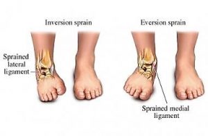 Types of ankle sprain