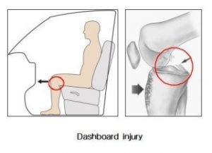 injury of PCL