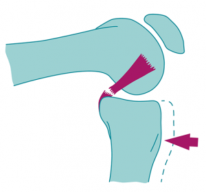 PCL Injury Rehabilitation