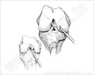 PCL reconstruction surgeries