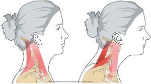 Forward Head Posture (