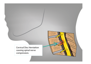 disc prolapse