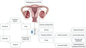 polycystic ovarian syndrome treatment
