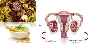 Symptoms of Polycystic Ovary Syndrome