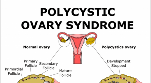 PCOS