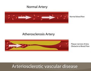 Atherosclerosis