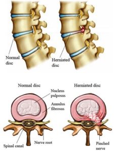 7-leading-back-injury