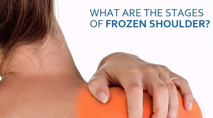 Frozen Shoulder Stages