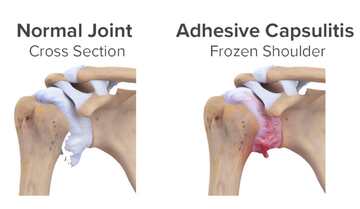 Frozen shoulder is adhesive Capsulitis