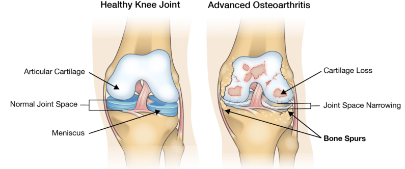 Degenerative Joint Pain