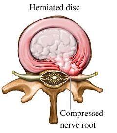 Herniated-Disc