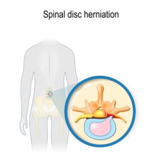 Optimized-spinal-disc-herniation-539x544