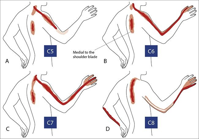 Symptoms-of-Cervical-Disc-Herniation