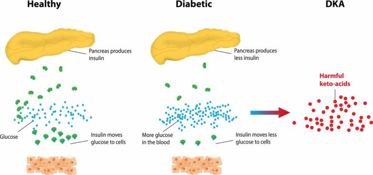 Diabetes-ketosis-768x362
