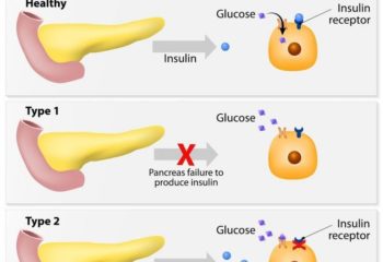 Health-and-Diabetes-type-1-and-type-2