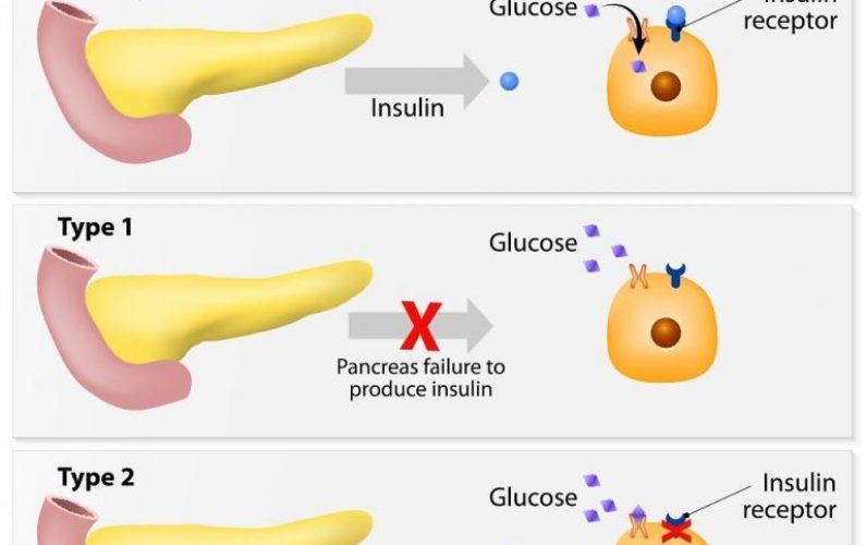 Health-and-Diabetes-type-1-and-type-2