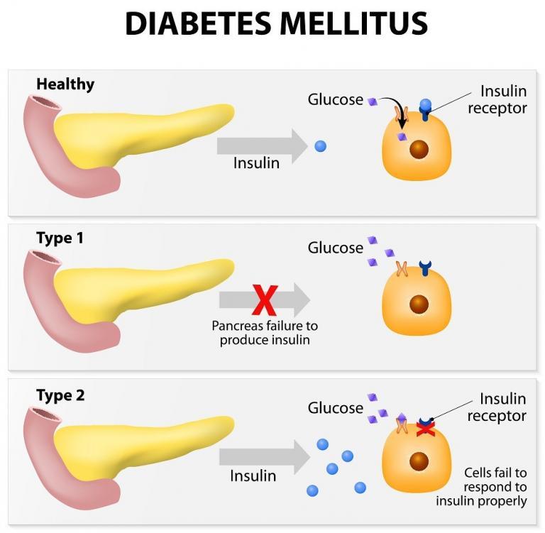 Health-and-Diabetes-type-1-and-type-2