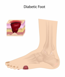 Diabetes causes limb amputations, disabilities and death