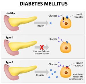 Diabetes mellitus type 1 and type 2