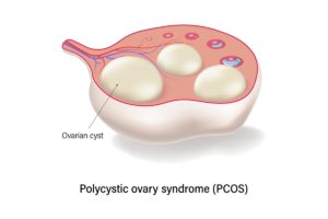 PCOS Diet 