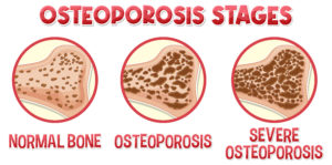 Informative poster of Osteoporosis human bone illustration